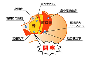 睡眠時無呼吸症候群とは?イラスト