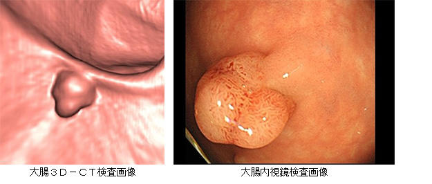 大腸３Ｄ－ＣＴ検査画像と大腸内視鏡検査画像